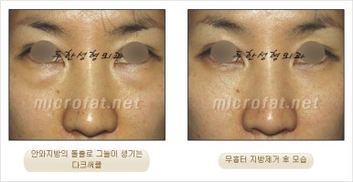두한성형외과 눈밑수술 - 다크서클 수술 전후 관리 안내 관련 이미지 47