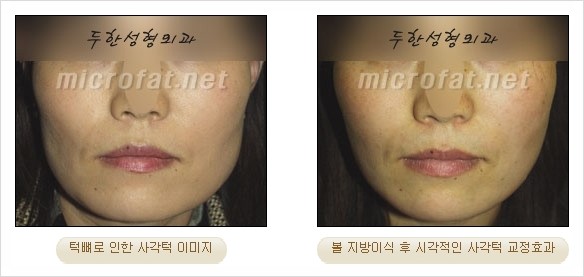 [두한성형외과 경쟁력 지방이식 리더] - [Col-fat(콜펫)지방이식, 3차원 입체지방이식, 2차원 평면지방이식] 관련 이미지 52