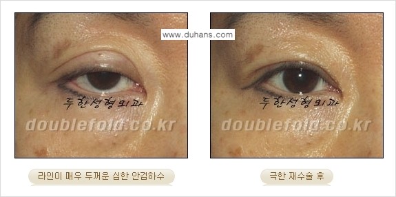 [두한성형외과 경쟁력 쌍꺼풀 재수술, 극한 눈재수술] - [망친 쌍꺼풀을 복원하는 극한 눈재수술] 관련 이미지 6
