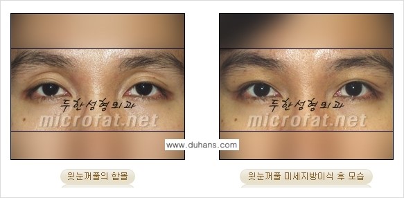[두한성형외과의 경쟁력 NO.1 지방이식] - [눈꺼풀 미세지방이식 관련 자주하는 질문과 답변] 관련 이미지 3