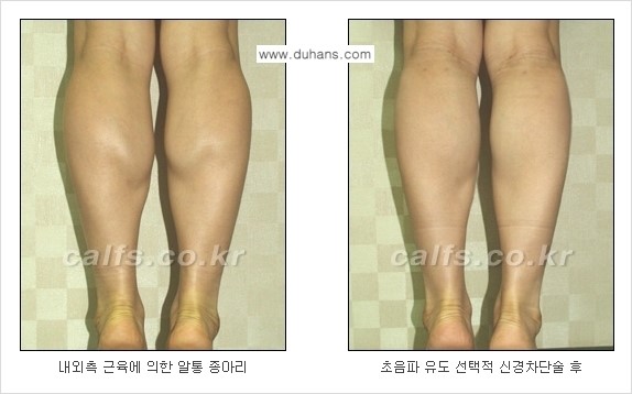 ​[두한성형외과와 날씬한 종아리 만들기!] - [간편하고 안전한 종아리 축소방법 ③] 관련 이미지 9