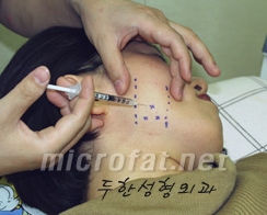 [두한성형외과 보톡스] - [사각턱 보톡스 시술 안내] 관련 이미지 8