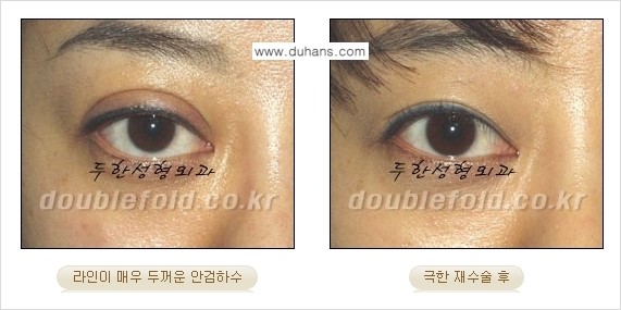 [두한성형외과 경쟁력 눈성형] - [극한의 상태에서 쌍꺼풀재수술(눈재수술) 안내] 관련 이미지 12
