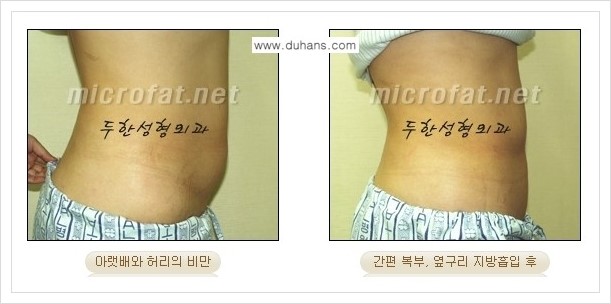 [두한성형외과 경쟁력 바디성형] - [하복부, 팔뚝, 허리선, 허벅지, 엉덩이 간편지방흡입술] 관련 이미지 12