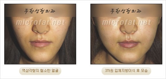 [두한성형외과 경쟁력 지방이식 리더] - [Col-fat(콜펫)지방이식, 3차원 입체지방이식, 2차원 평면지방이식] 관련 이미지 54