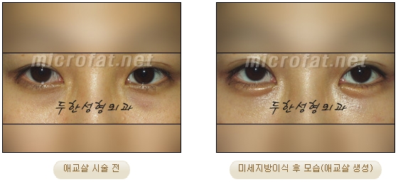 ​[두한성형외과 지방이식] - [애교살] 관련 이미지 17