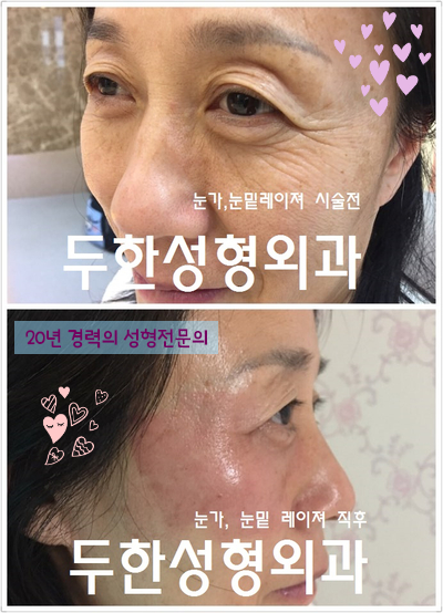 [Duhan Plastic Surgery Ophthalmic Plastic Surgery] - [Lower Blepharoplasty] image 36