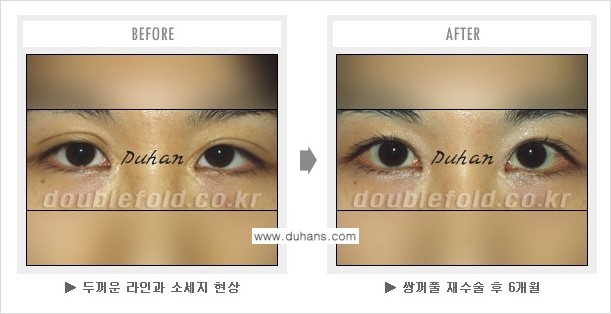 [두한성형외과 NO.1 쌍꺼풀 재수술] - [쌍꺼풀 재수술 - 푸는 수술을 하고 내원했을 경우의 문제] 관련 이미지 5