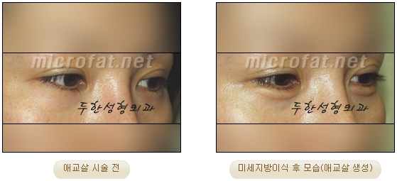 ​[두한성형외과 지방이식] - [애교살] 관련 이미지 12