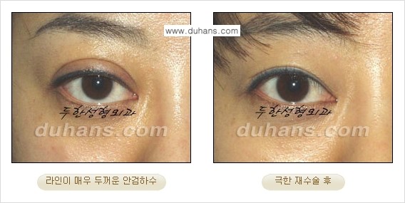 ⁠⁠⁠⁠[두한성형외과 성형 FOCUS] - [정상적인 눈매로의 복원 극한재수술 경우 ①] 관련 이미지 13