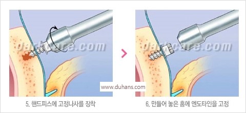 [두한성형외과 경쟁력 주름성형] - [주름제거와 볼륨을 갖게하는 엔도타인 리프팅] 관련 이미지 33