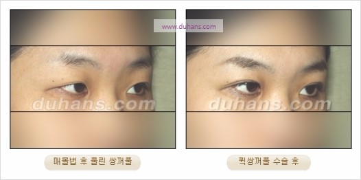 [두한성형외과 경쟁력 눈성형] - [자연스럽고 아름다운 눈매를 만드는 여러 가지 눈성형 방법] 관련 이미지 16