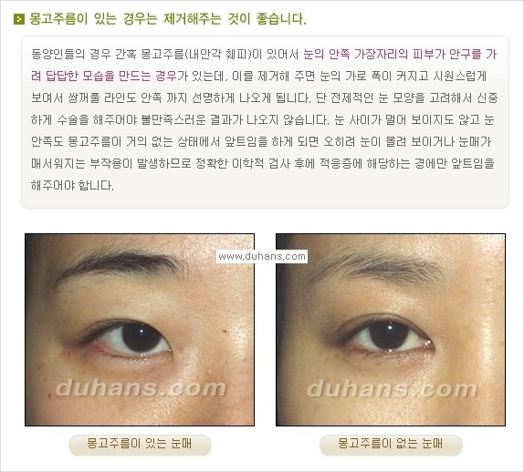 [두한성형외과 경쟁력 눈성형] - [눈성형, 쌍꺼풀 수술 방법에 관한 자주하는 질문과 답변 안내] 관련 이미지 5