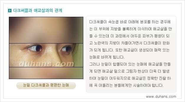[두한성형외과 경쟁력 눈밑성형] - [눈밑 애교살 시술을 위한 미세지방이식 안내] 관련 이미지 2