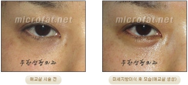 두한성형외과 눈밑성형 - 애교필러 후 눈밑재수술 관련 이미지 50