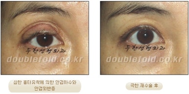 쌍꺼풀수술 두한성형외과 - 쌍커풀재수술의 문제점 관련 이미지 21