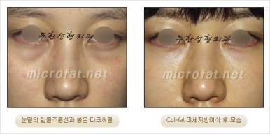 두한성형외과 눈밑수술 - 다크서클 수술 전후 관리 안내 관련 이미지 13