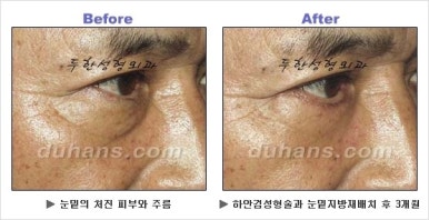 [두한성형외과 안검성형] - [상안검, 하안검] 관련 이미지 59