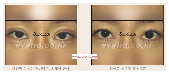 [두한성형외과 경쟁력 눈성형] - [절개법, 매몰법의 수술 방법] 관련 이미지 11