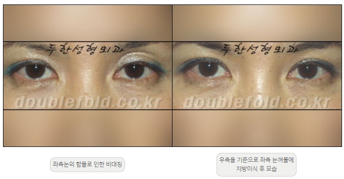 [두한성형외과 쌍커플재수술] - [비대칭 쌍커풀 라인] 관련 이미지 24