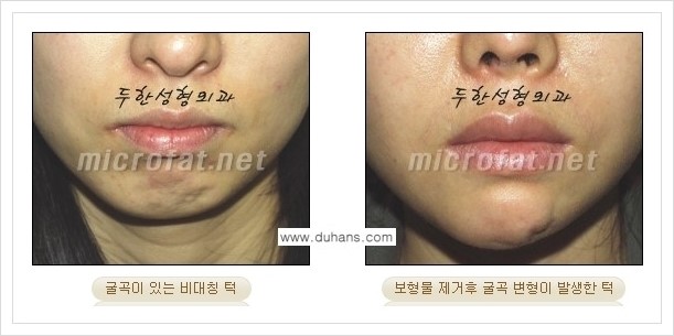 [두한성형외과 경쟁력 미세지방이식] - [얼굴 윤곽 무턱교정 안내 ①] 관련 이미지 3