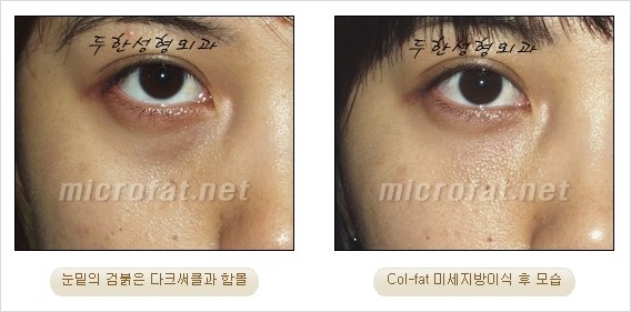 ​[두한성형외과 경쟁력 눈밑성형 리더] - [눈밑 다크써클의 증상, 원인, 종류, 치료방법 안내] 관련 이미지 25