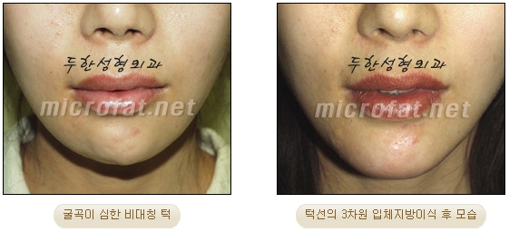 [두한성형외과 미세지방이식] - [무턱교정 안내] 관련 이미지 21