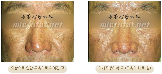 [두한성형외과 지방이식] - [지방이식을 이용한 코성형] 관련 이미지 17
