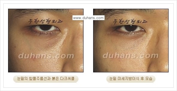 [두한성형외과 경쟁력 눈밑성형] - [다크써클과 눈밑주름을 위한 미세지방이식 안내] 관련 이미지 7