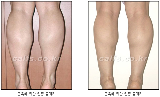[두한성형외과 종아리퇴축술] - [NO절개! 초음파유도신경차단술] 관련 이미지 5