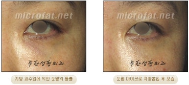 Facial Fat Liposuction at Duhan Plastic Surgery - Cheek Fat Liposuction, Jawline Liposuction, Under-Eye Fat Liposuction image 15