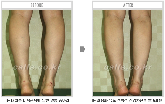 [종아리성형 두한성형외과] - [종아리수술에 대한 자주하는 질문과 답변 모음] 관련 이미지 67