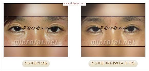 [두한성형외과 경쟁력 눈성형 리더] - [윗눈꺼풀 함몰( #꺼진눈꺼풀) 미세지방이식과 상안검성형]#꺼진눈성형 , #눈위함몰 관련 이미지 35
