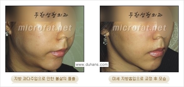 [두한성형외과 경쟁력 미세지방이식] - [타 병원에서 볼살 지방이식 이후 부작용 교정 방법 안내] 관련 이미지 13