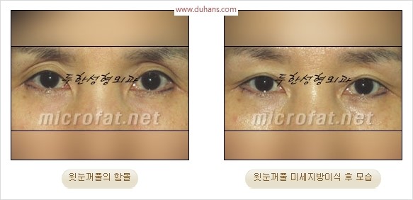 [두한성형외과 경쟁력 눈성형 리더] - [윗눈꺼풀 함몰( #꺼진눈꺼풀) 미세지방이식과 상안검성형]#꺼진눈성형 , #눈위함몰 관련 이미지 11