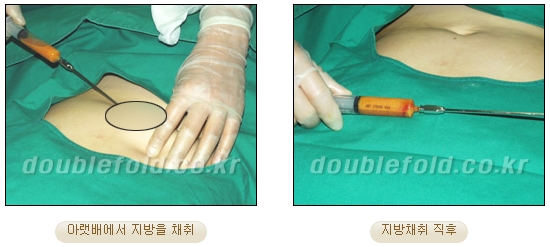 쌍커풀수술 두한성형외과 - 쌍꺼풀라인낮추기 관련 이미지 15