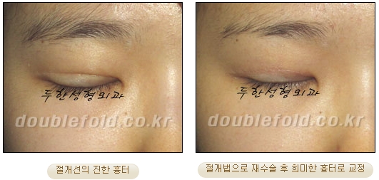 [두한성형외과 쌍커풀수술] - [눈성형 방법에 대한 자주하는 질문과 답변] 관련 이미지 23