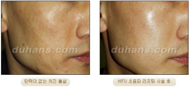 두한성형외과 주름개선 - 주름 HIFU 리프팅 관련 이미지 23