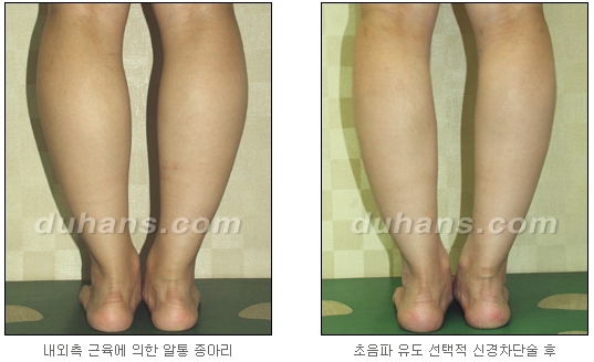 [Duhan Plastic Surgery Calf Reduction] - [How to Get Rid of Calf Muscle Bulges] image 27
