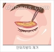 [두한성형외과 경쟁력 눈성형] - [젊은 눈매로의 복원 안검성형] 관련 이미지 5