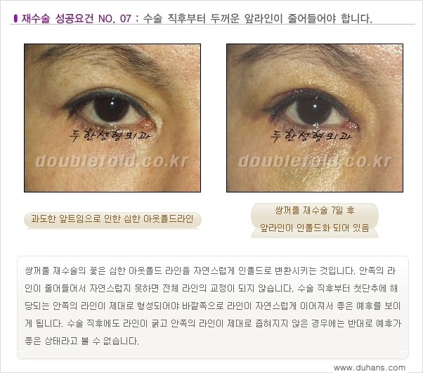 [두한성형외과 무한 경쟁력 "극한 눈(쌍꺼풀) 재수술"] - [극한 눈(쌍꺼풀) 재수술 성공요건!] 관련 이미지 8
