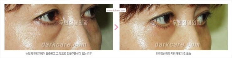 [두한성형외과 경쟁력 눈밑성형] - [눈밑 다크써클 맞춤 치료 방법] 관련 이미지 10