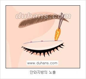 ​[두한성형외과 경쟁력 눈성형] - [자연스러운면서 매력적인 쌍꺼풀 퀵 쌍꺼풀 수술 안내] 관련 이미지 9
