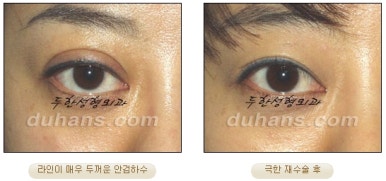 [Special Double Eyelid Revision Surgery at Duhan Plastic Surgery] - [Restorative Surgery for Damaged Double Eyelid Eye Shape] image 15