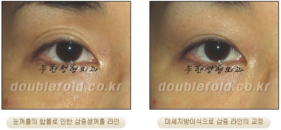 [두한성형외과 눈재수술] - [재수술 방법들] 관련 이미지 27
