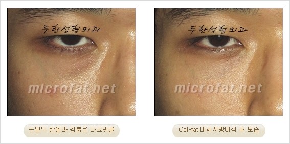 ​[두한성형외과 경쟁력 눈밑성형 리더] - [눈밑 다크써클의 증상, 원인, 종류, 치료방법 안내] 관련 이미지 28