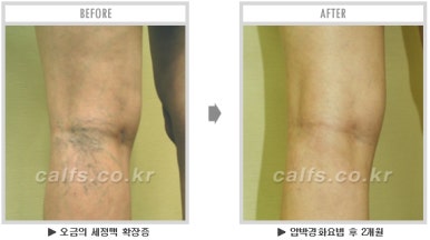 ​[두한성형외과 종아리수술] - [나에게 맞는 종아리성형방법] 관련 이미지 49