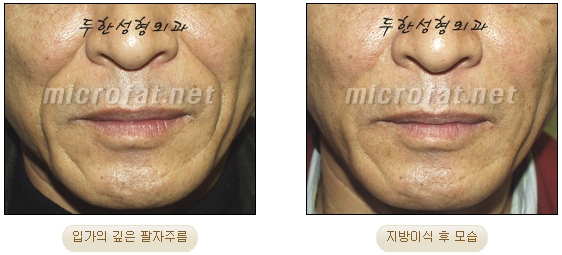 Wrinkle Improvement, Duhan Plastic Surgery - Mouth Lines, Nasolabial Folds image 19