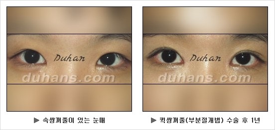 [두한성형외과 쌍커풀수술] - [눈성형 방법에 대한 자주하는 질문과 답변] 관련 이미지 127