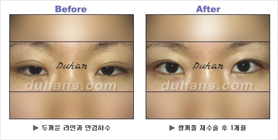 [두한성형외과 경쟁력 쌍꺼풀 재수술] - [안검하수 성형 흔한 질문과 답변 모음] 관련 이미지 8